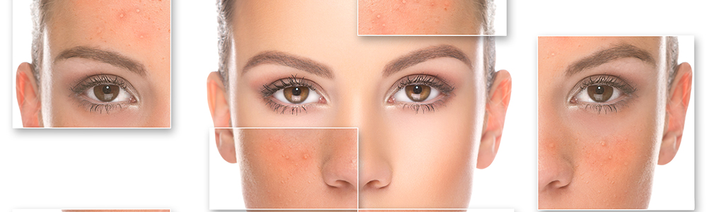 What is Accutane and How Does it Help My Skin